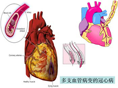 常見(jiàn)病冠心病