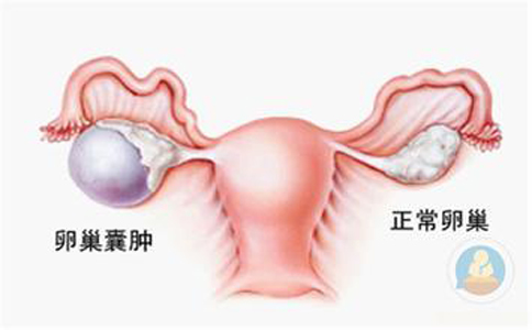 卵巢囊腫，抱腿壓涌泉穴，給你愛心呵護(hù)